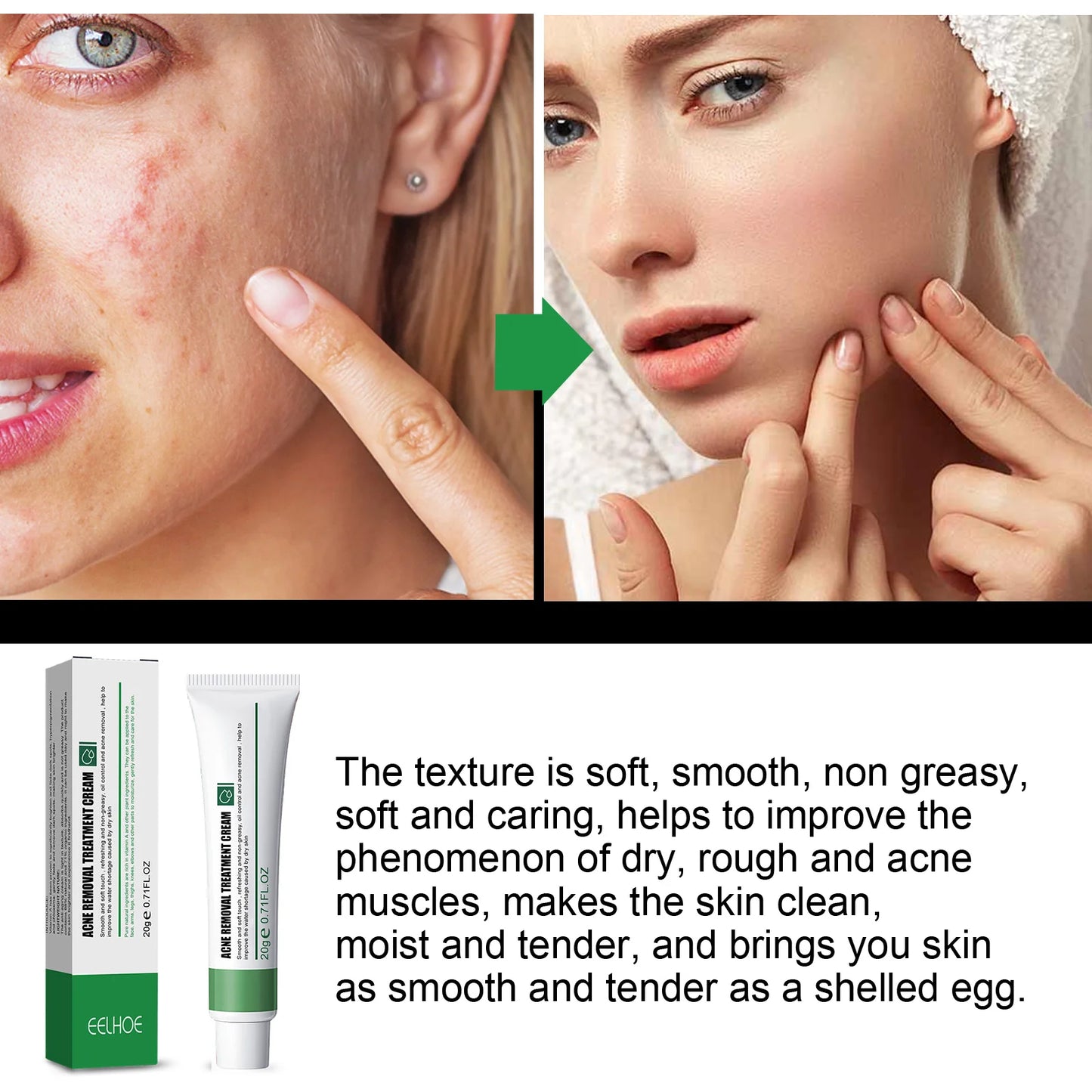 EELHOE Blemish & Acne Treatment Cream Brightens Skin Tone Hydrates & Repairs Complexion