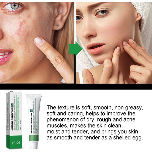 EELHOE Blemish & Acne Treatment Cream Brightens Skin Tone Hydrates & Repairs Complexion